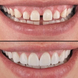 Виниры для зубов Perfect Smile Veneers / Съемные виниры / Накладные зубы / Накладки для зубов, Белый
